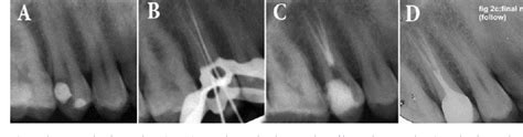 Figure 1 from Root Canal Treatment of a Maxillary Second Premolar with Two Palatal Root Canals ...