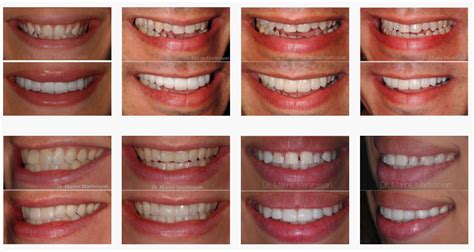 What Veneers Do: With Before and After Pictures Included | Pacific ...