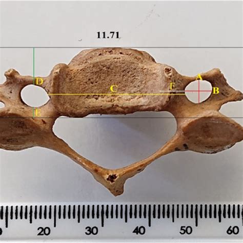 Morphometric analyses of foramen transversarium mean dimensions of male... | Download Scientific ...