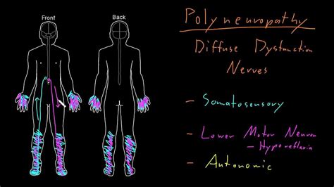 Syndrome: Polyneuropathy - YouTube