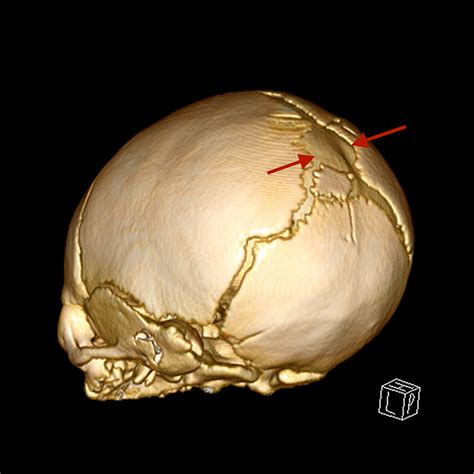 Cureus | Posterior Fontanelle Encephalomeningocele in a Neonate: A Case ...