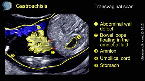 Gastroschisis - YouTube