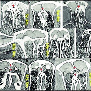 The Frontal Sinus & Septum's appearance at various ages of development ...