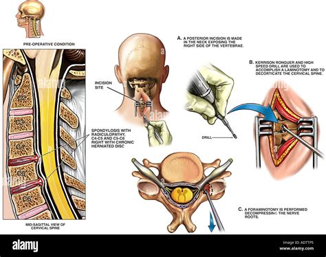 Spine Surgery - C4-C5 and C5-C6 Cervical Laminotomy and Foraminotomy Stock Photo: 7710308 - Alamy