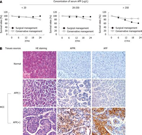 Elevated serum alpha fetoprotein levels promote pathological progression of hepatocellular carcinoma