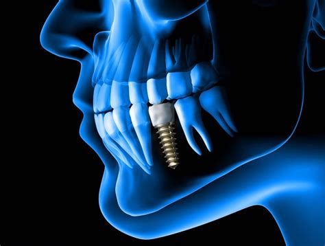 Nanobiotechnology Used to Improve Safety of Titanium Dental Implants