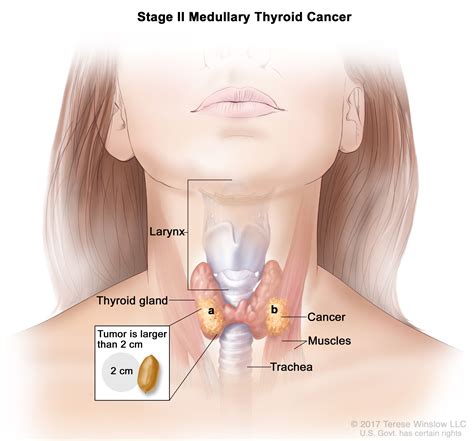 Thyroid Cancer | UCSF Department of Surgery