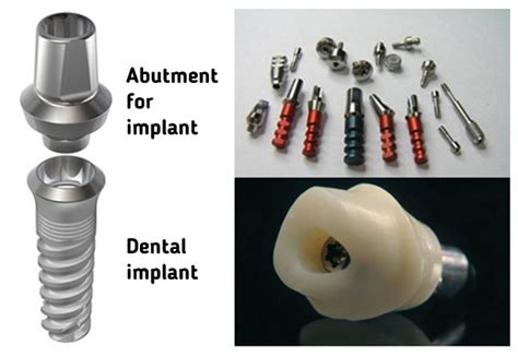 Abutments for implants | Implant centre Martinko