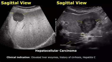 Liver Ultrasound Reporting | Liver Diseases Scan Reports | How To Write USG Report | Abdominal ...