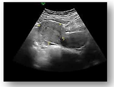 Ruptured Ectopic Pregnancy Ultrasound