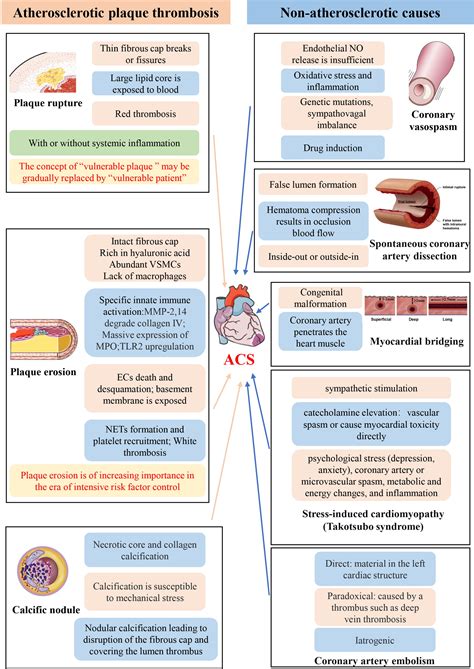 New Concepts on the Pathophysiology of Acute Coronary Syndrome