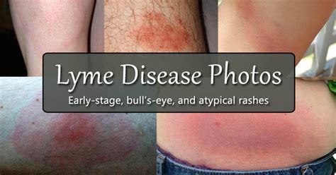 Lyme Disease Rash Photos: Early-Stage, Bull’s-Eye, and Atypical Rashes - Mom Goes Camping