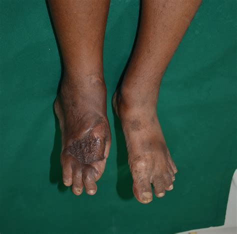 DIABETIC FOOT - GROSS INFECTION RIGHT FOOT - GREAT TOE AMPUTATED ...