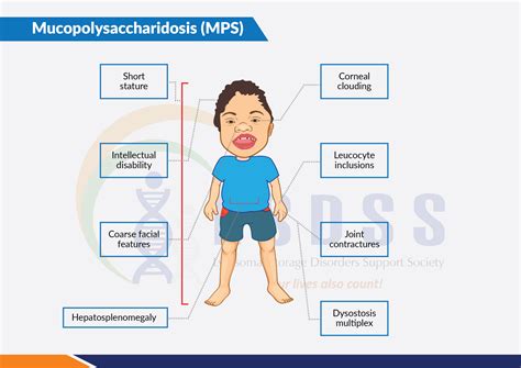 Mucopolysaccharidosis | LSDSS India