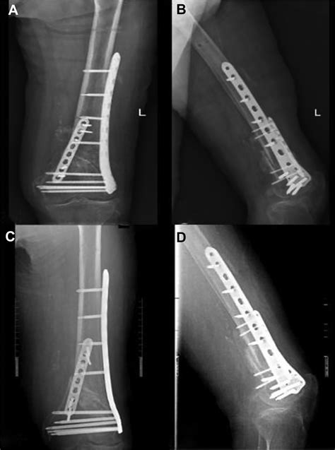 A Double-plating Approach To Distal Femur Fracture: A, 58% OFF