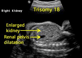 Gallery 6: Trisomy 18 | OB Images