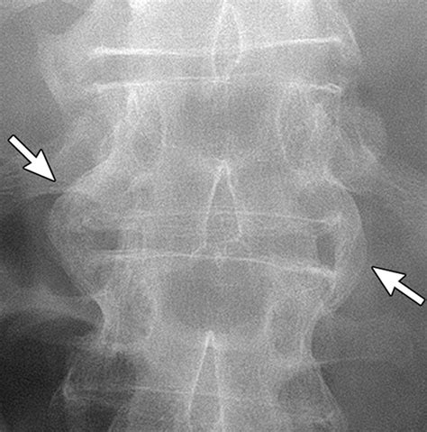 Psoriatic arthritis. (a) Anteroposterior sacrum radiograph shows bone erosions and narrowing of ...