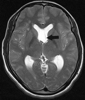 (left): 28 year old female with septum pellucidum subependymoma. MRI... | Download Scientific ...