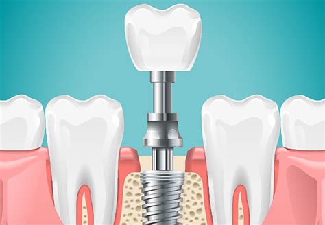 Mini Dental Implant | Thomas E. Wright III DDS | Houston Periodontist - Texas City Periodontist