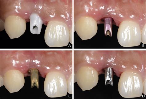 Different types of abutments in place. A, Zirconia abutment. B,... | Download Scientific Diagram