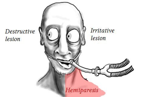 Examination of eye movements (CN III, IV, VI) | Deranged Physiology