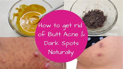 How To Get Rid Of Butt Acne, Butt Pimple and Butt Acne Scars. Hips Ke ...