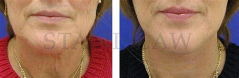 Facelift Expert in Connecticut | Rhytidectomy Surgery Hartford