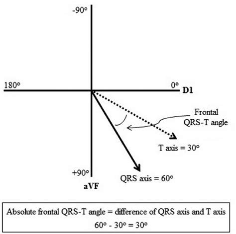 An illustration of the measurement of frontal QRS-T angle. | Download ...