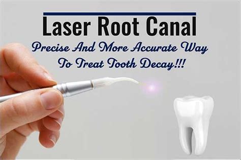 Laser Root Canal Treatment Cost in Chennai | Laser Dentistry India