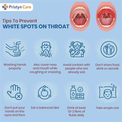 White Spots On Throat Symptoms