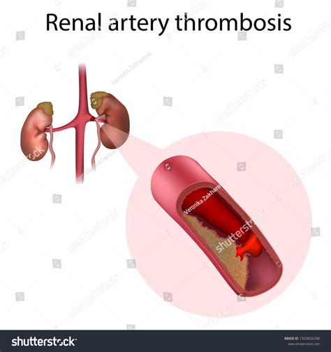 526 Renal Vascularity Images, Stock Photos & Vectors | Shutterstock