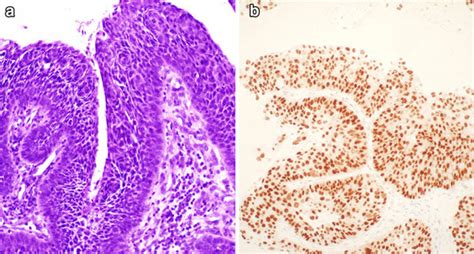 Papillary squamous cell carcinoma. Papillary pattern of growth, with ...