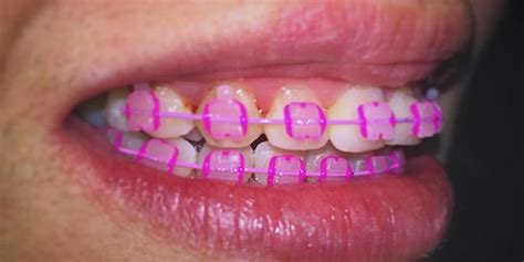 pink-braces – Braces Explained