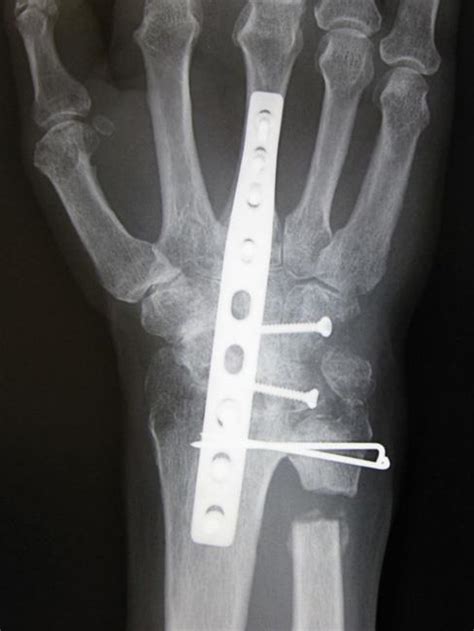 Arthritis of the Wrist - Orthopedic & Sports Medicine