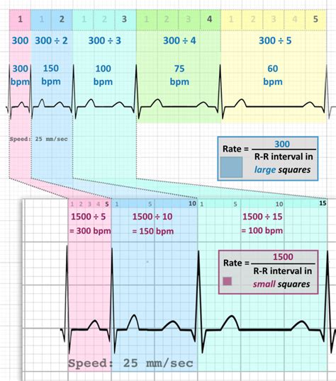 Calculate Heart Rate Ekg Strip | Images and Photos finder