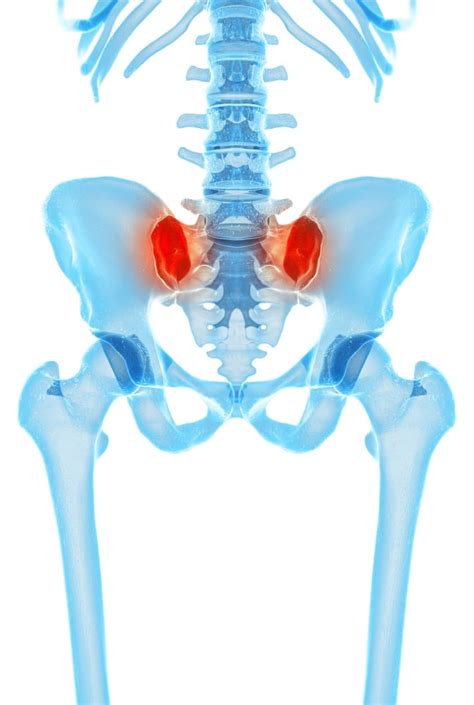 Sacroiliac joint pain | Spine Plus