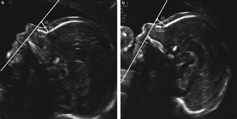 Trisomy 18 Ultrasound Markers