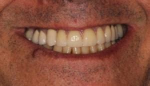 Implant Retained Partial Denture 1 - VDSC