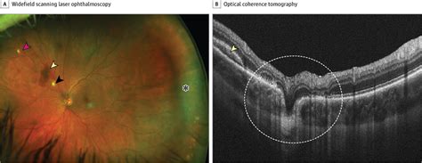 Imaging of Ocular Perforation After Retrobulbar Block. | Anesthesiology | JAMA Ophthalmology ...