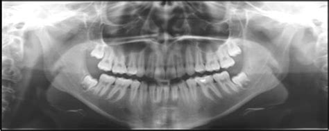 Radiology on Jaw Bone Lesions PDF Free Download ~ Dentistry and Medicine