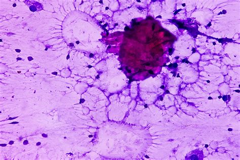 Breast Fat Necrosis: What Is It, Signs and Causes