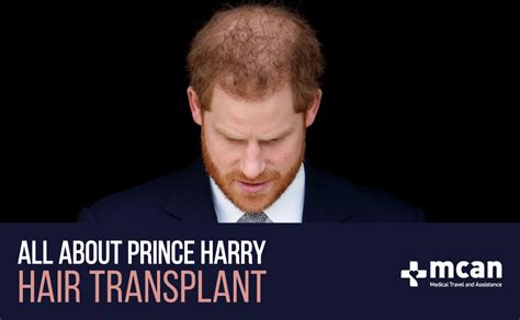 Prince Harry hair transplant and his hair loss