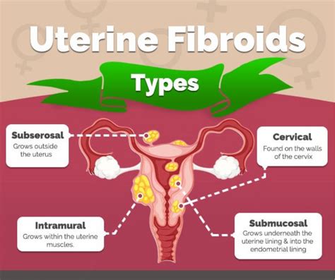 Fibroids Treatments Singapore - Dr.Pamela Tan, Gynaecologist Singapore