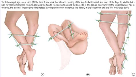 Designs of the external fixator framework | Download Scientific Diagram