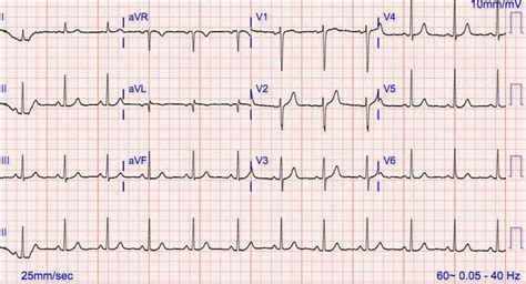 Sinus rhythm, normal sinus rhythm & sick sinus rhythm