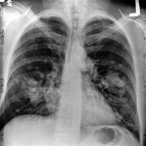 Dark Lung Spots on X-Ray | hubpages