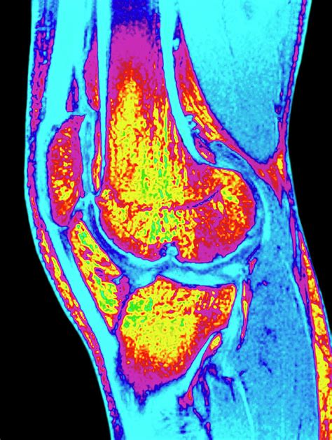 Colour Mri Scan Of Knee Joint With Osteoarthritis Photograph by Simon ...