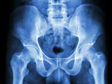 Male Vs Female Pelvis X Ray