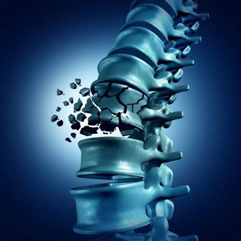 Understanding Kyphoplasty Recovery Time: A Comprehensive Guide — Michael Rock MD Chicago ...