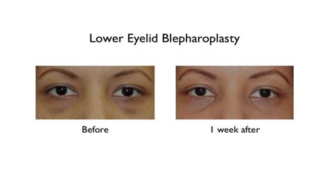 Eye Bag Surgery with Fast Recovery - New York City and Garden City, NY